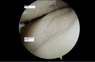 the form of the astroscope to the knee joint with osteoarthritis of the 3rd degree