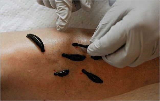 treatment of the knee joint with leeches