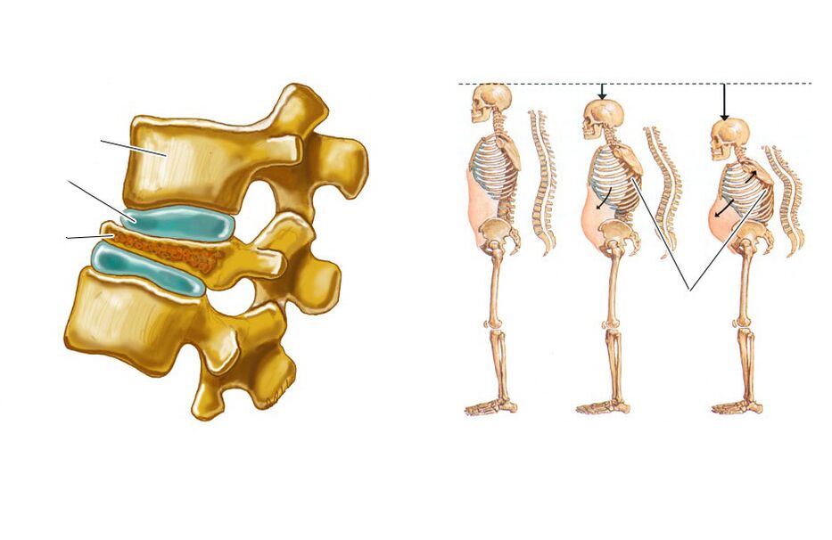 a relaxation of the spine leads to back pain