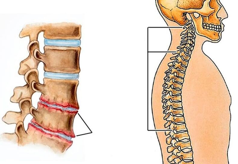 the curvature of the spine leads to back pain