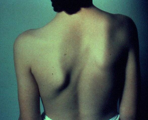 Sprengel disease as a cause of pain below the left shoulder