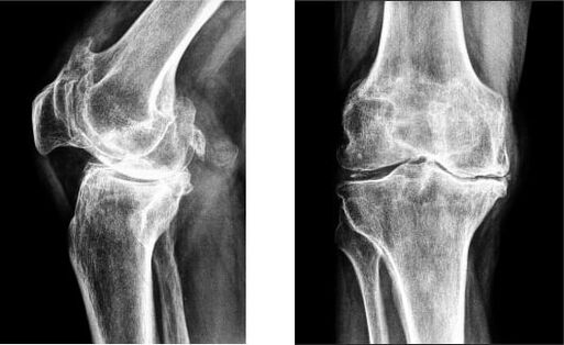 Knee joint on X-ray