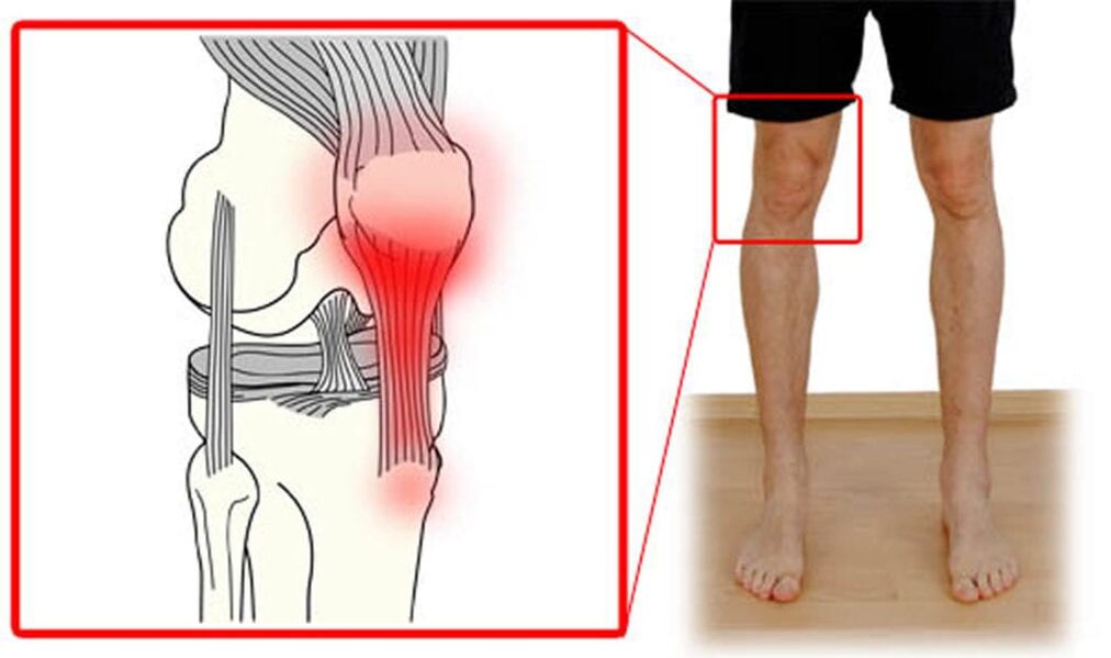 Tendonitis - inflammation of the tendons in the knee joint