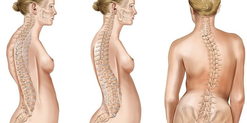 Scoliosis of the thoracic spine causes pain in the shoulders