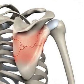 Shoulder fracture is one of the causes of severe pain