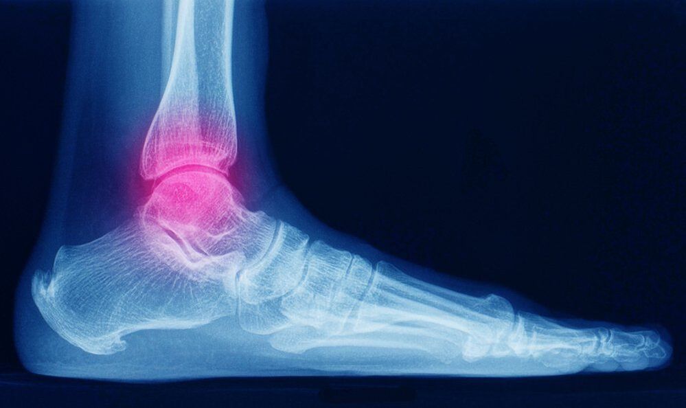 symptoms of ankle arthropathy