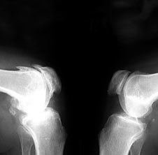 Osteoarthritis on x-ray