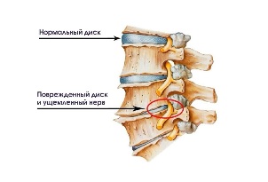 The symptoms of cervical degenerative disc disease