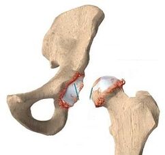 causes of hip joint