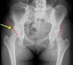 methods of treatment of the hip joint