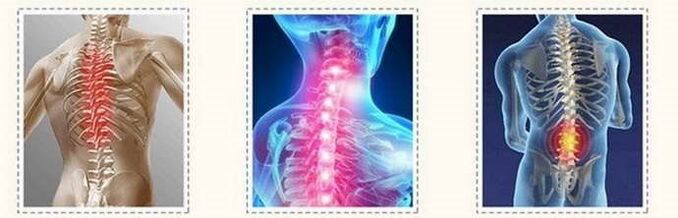 vertebral lesions with osteochondrosis