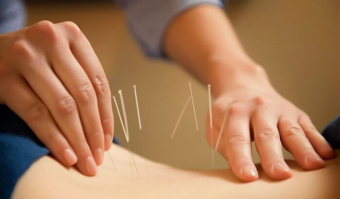 acupuncture for the treatment of back pain