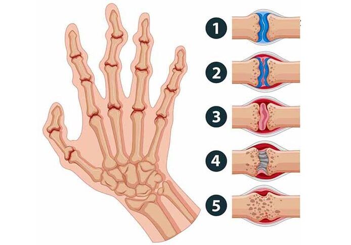 stages of arthritis of the finger joints